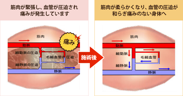 筋肉が柔らかくなり、血管の圧迫が和らぎ痛みのない身体へ
